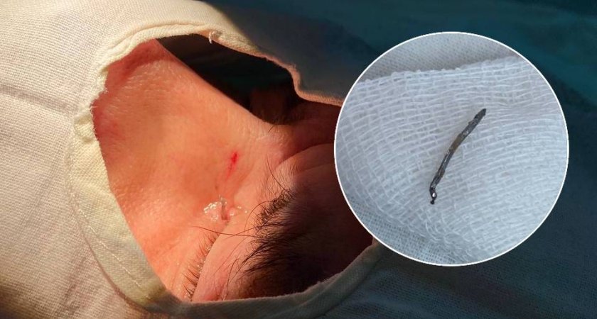 В Чебоксарах врачи вытащили железную скобу, врезавшуюся мужчине в уголок глаза 
