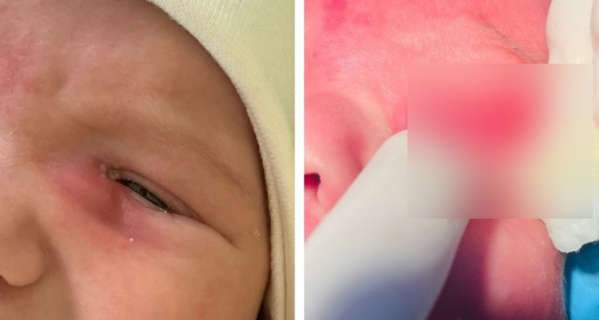 Двухмесячный младенец постоянно плакал, пока врачи не провели экстренную операцию на глазу