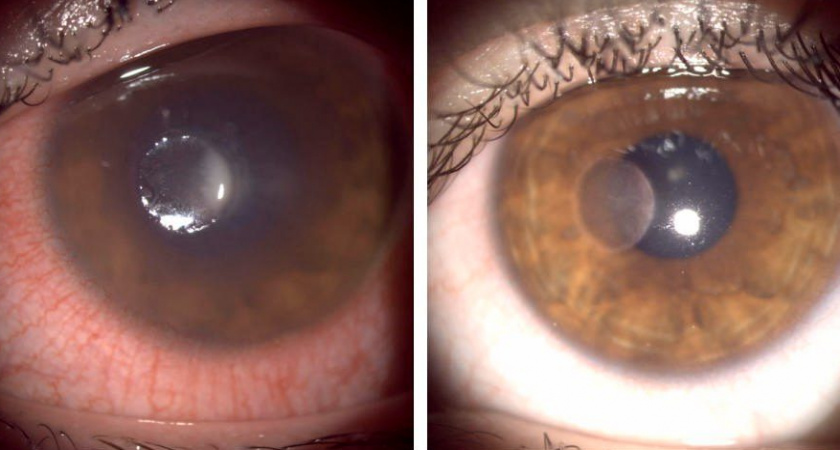 Линзы могут привести к слепоте: 16-летняя жительница Чувашии получила язву глаза, и зрение упало до 5 %