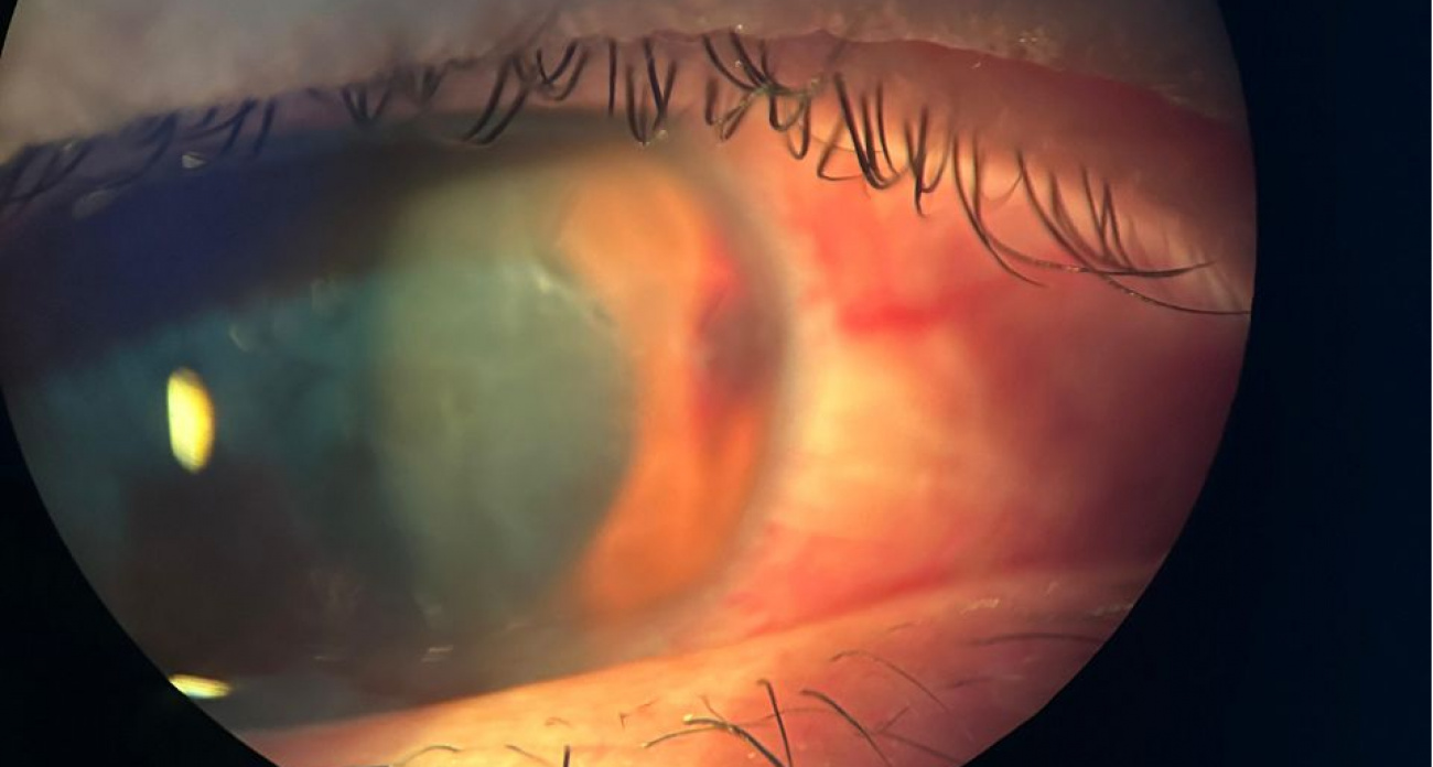 В Чувашии дачник косил траву и чуть не ослеп: случилась контузия глазного яблока, и зрение резко упало