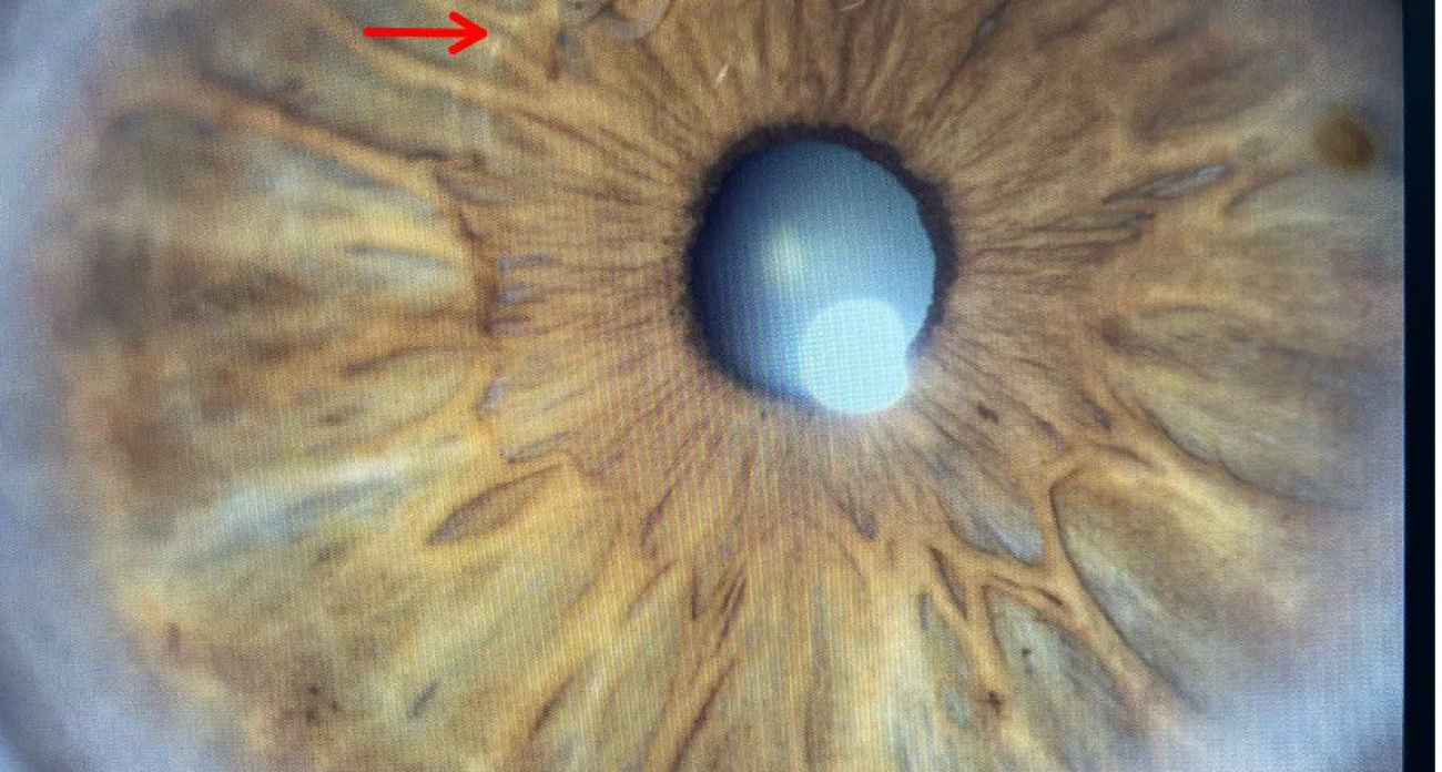 У жителя Чувашии обнаружили червя в глазу
