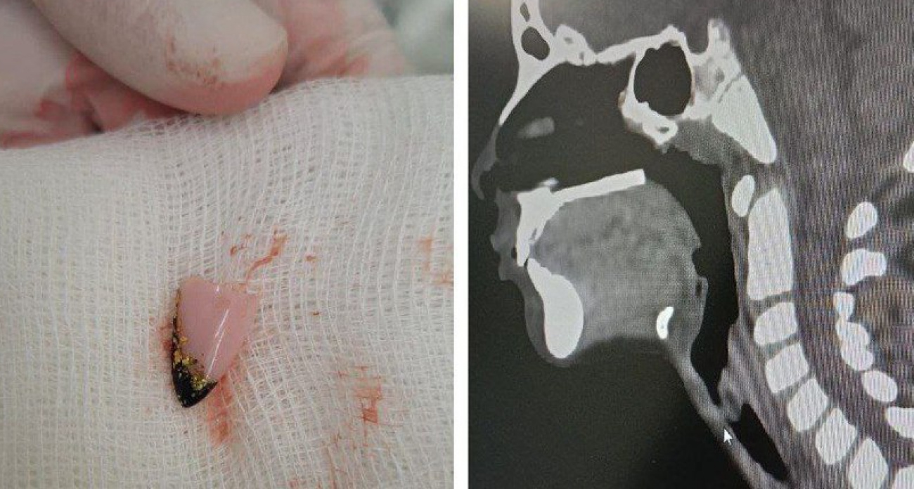 Шестилетний ребенок в Чувашии проглотил женский ноготь