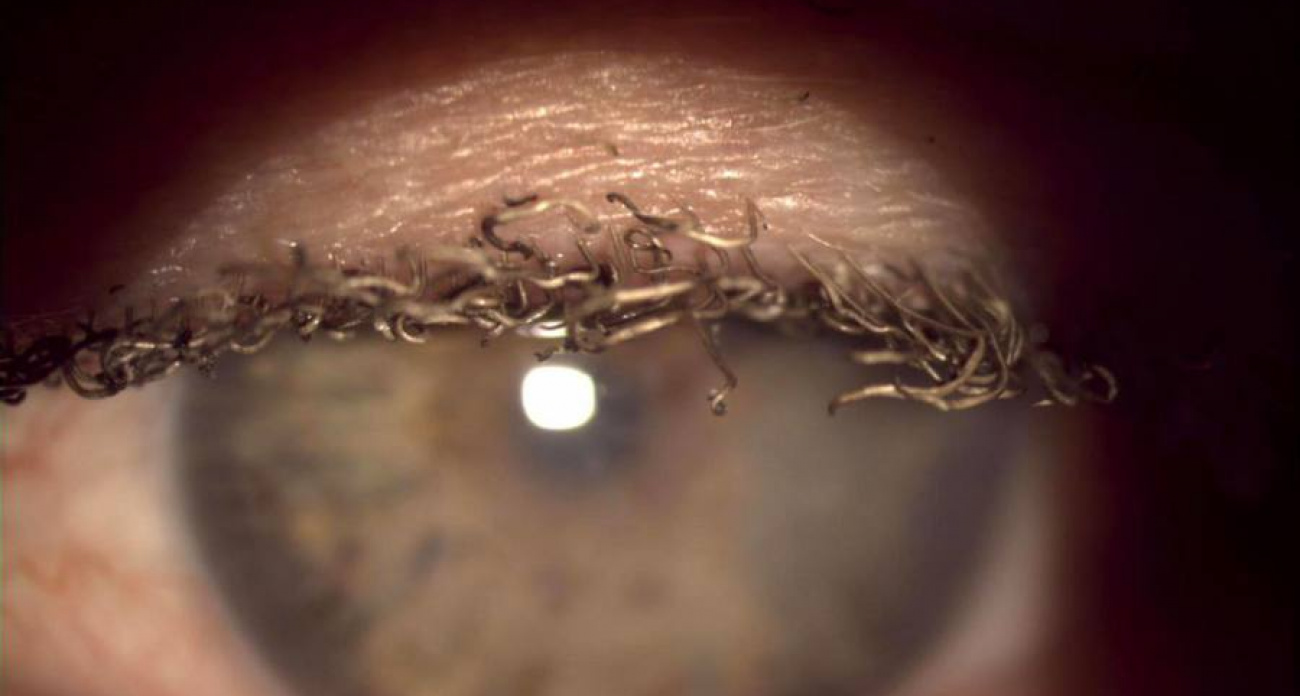 В Чувашии спасли зрение мужчине, который выжег себе глаза в электрощитовой