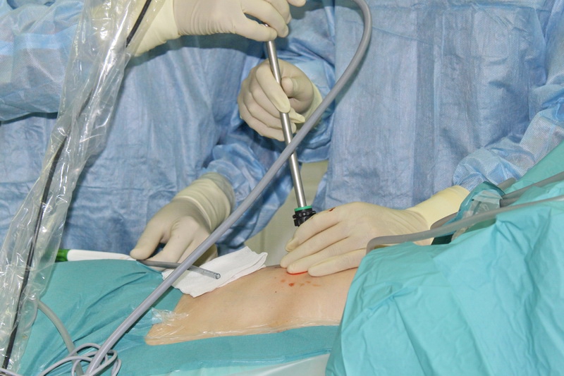 Чебоксарские врачи провели уникальную операцию пациенту с раком легких