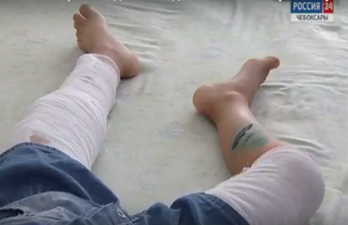 В Чебоксарах врачи по частям собрали ногу пятилетней девочки