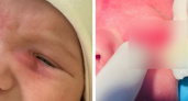 Двухмесячный младенец постоянно плакал, пока врачи не провели экстренную операцию на глазу