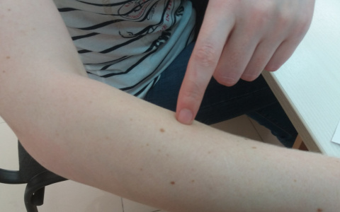 Врачи просят чебоксарцев прислать фотографию родинки на проверку