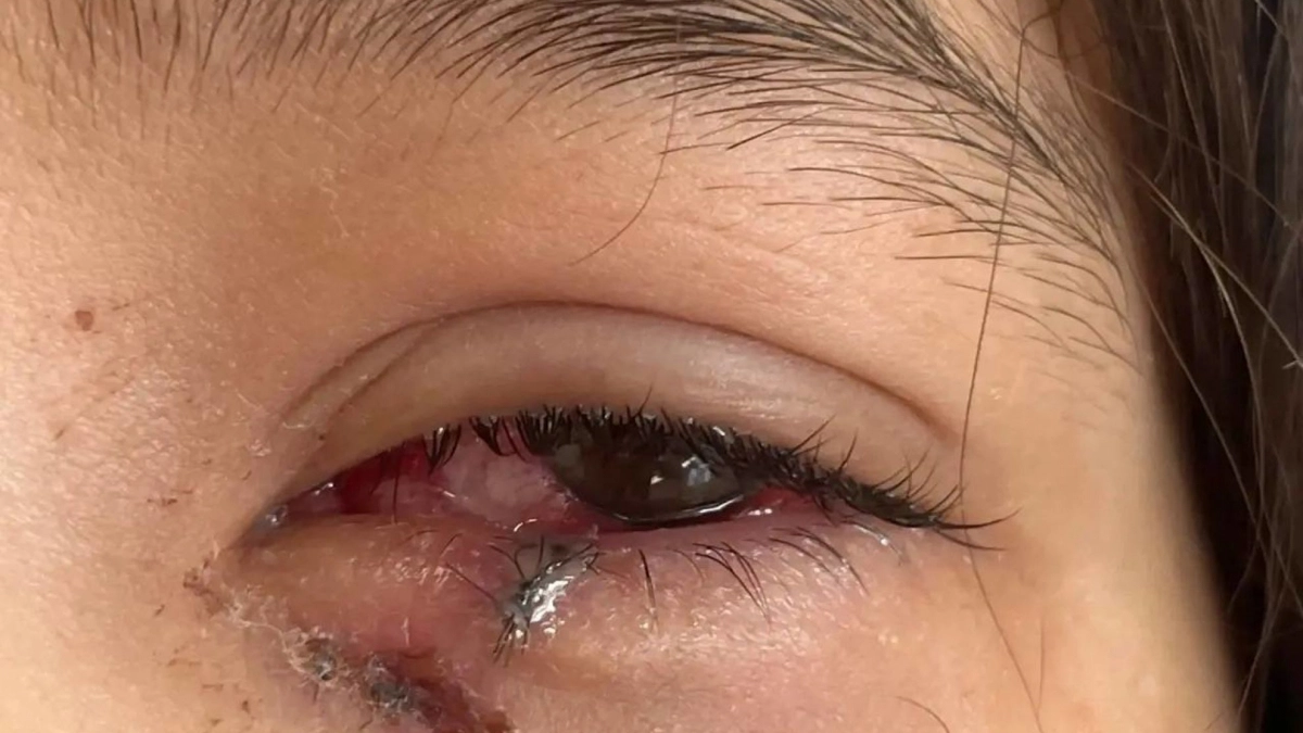 Обычная прогулка обернулась для девушки из Чувашии падением глазом на камыш