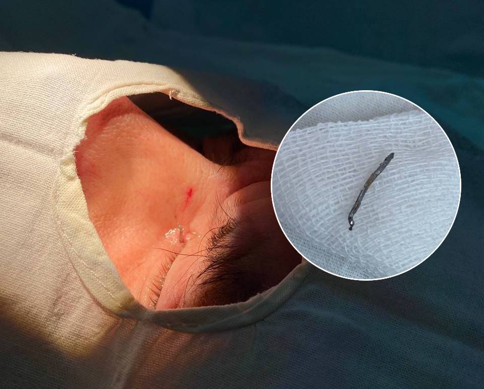 В Чебоксарах врачи вытащили железную скобу, врезавшуюся мужчине в уголок глаза 
