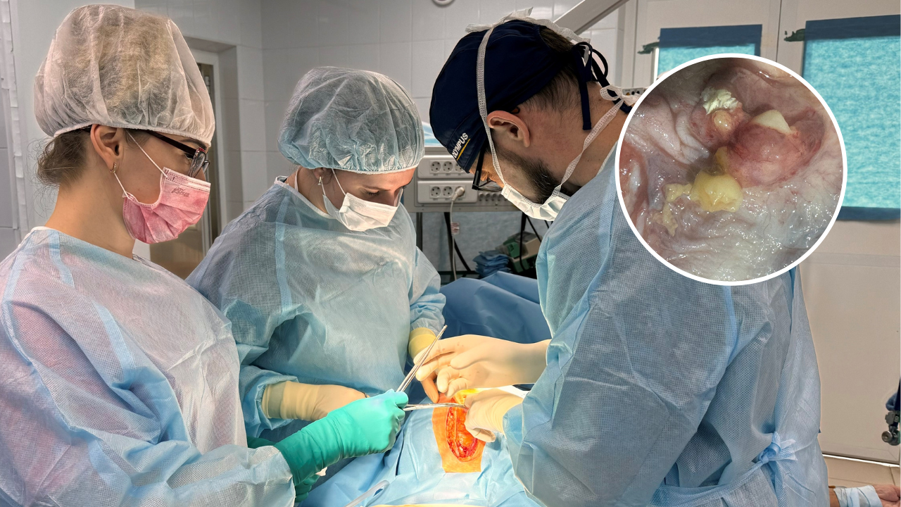В Чебоксарах врачи достали из живота женщины 40-сантиметровую опухоль с зубами и волосами