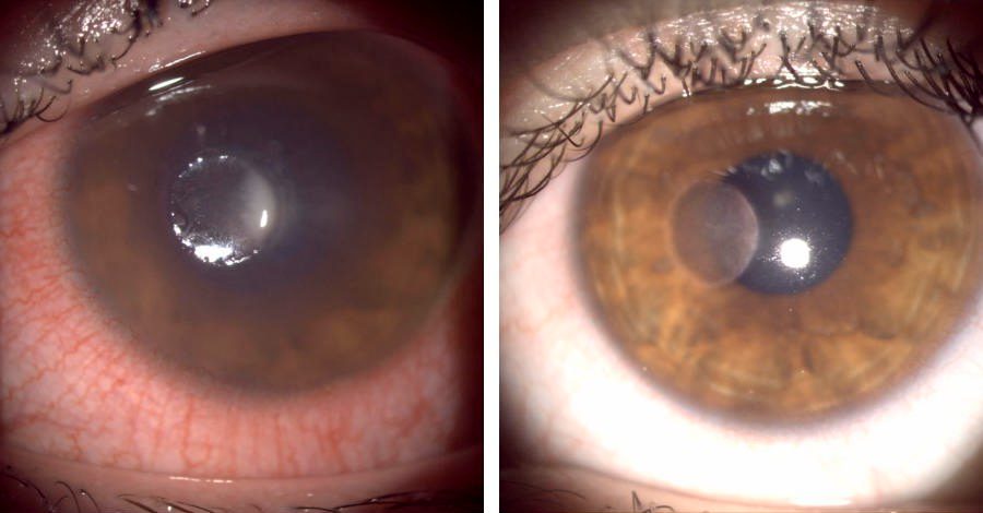 Линзы могут привести к слепоте: 16-летняя жительница Чувашии получила язву глаза, и зрение упало до 5 %